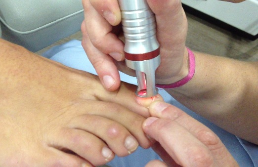 Tratamiento láser para las uñas del pie infectadas por hongos. Daniel Mayral Esteban. Podólogo en el Hospital Quirón Teknon.