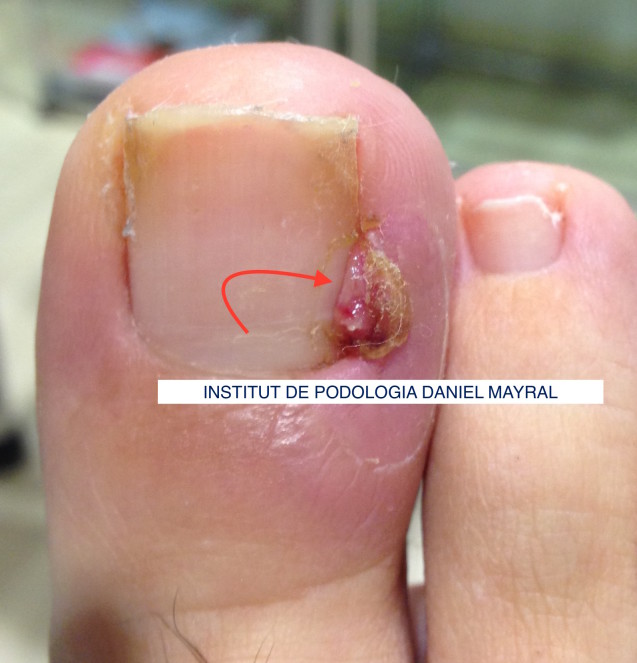 Granuloma piogénico o protuberancia en la zona ungueal de la uña del pie.