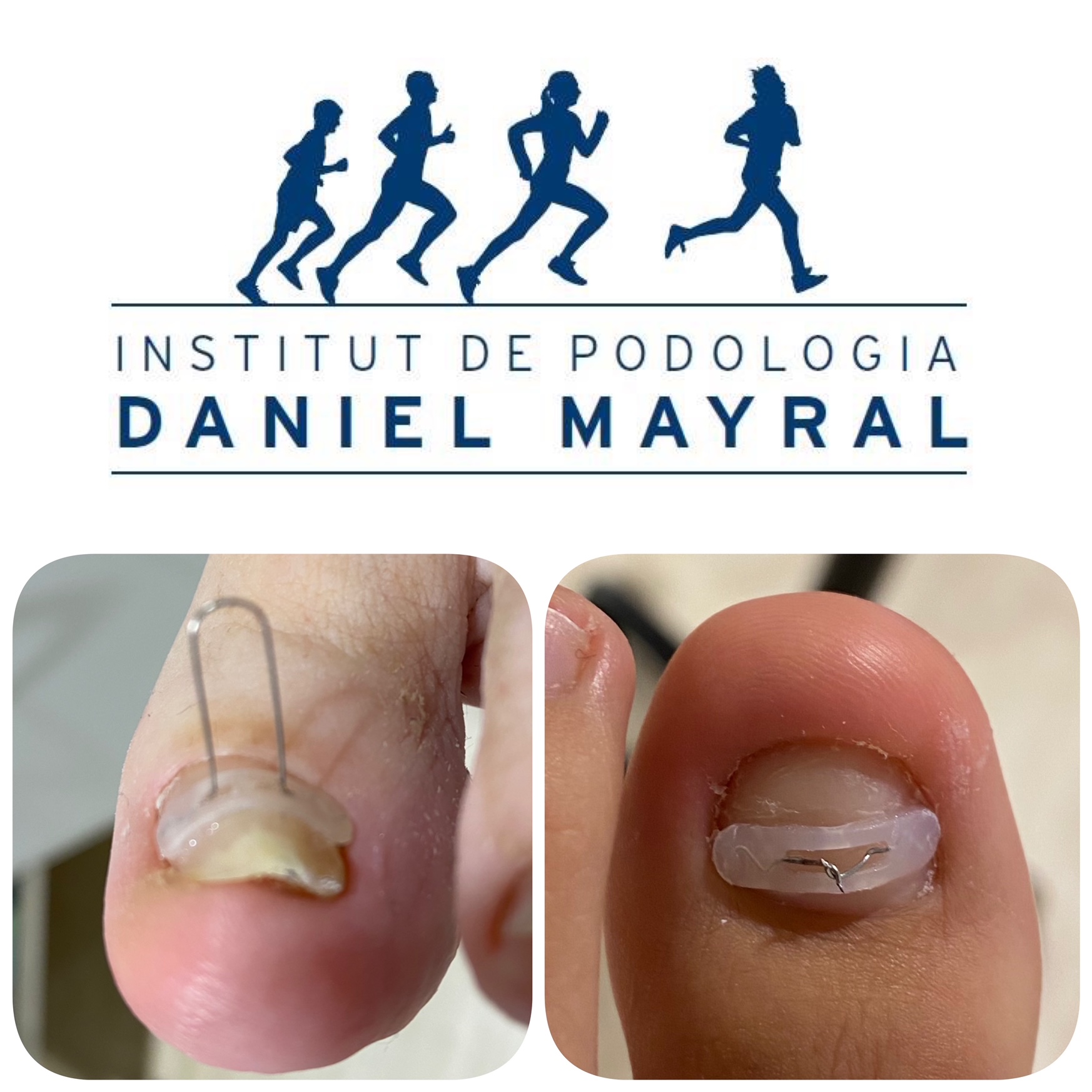 asignar Interesar Murciélago ORTONIXIA ,la "ortodoncia" de las uñas de los pies. | institut daniel  mayralinstitut daniel mayral