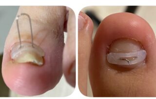 Imàgenes de curación de una uña mediante ortonixia.