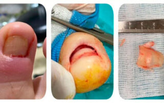 ¿Sabemos que es la retroniquia?