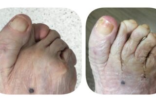 Fotografía de un pie reumático de antes y de después de la operación.