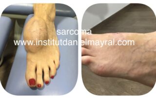 Fotografía de antes y de después de la operación de un pie con sarcoma fibroblástico.