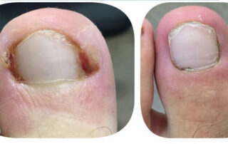 Fotografía de antes y de después de un dedo con uña encarnada.